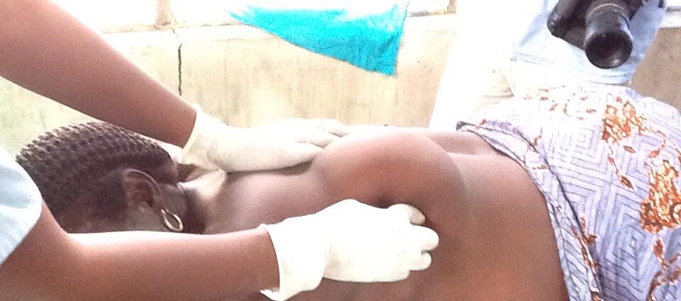 A woman with lipoma at the back before surgery