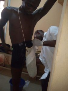 Fabrication-of-artificial-limb-for-disi