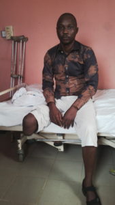 Payen-before-fabrication-of-artificial-limb
