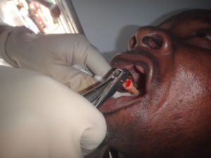 Dental extraction of teeth in progress